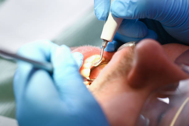 Emergency Dental Filling Replacement in NM